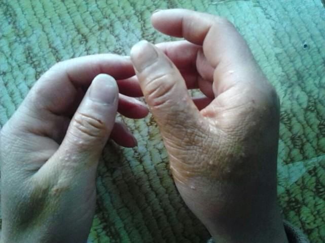 手上起小水泡痒怎么办? 2种做法, 看一眼就会