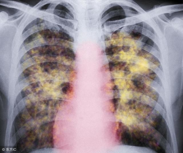 这个是肺上有什么问题?