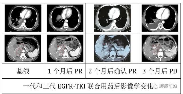 研究进展:吉非替尼联合9291克服肿瘤三代耐药