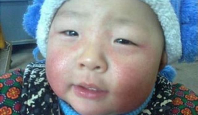 脸上痤疮老不好,去医院检查,医生说是系统性红