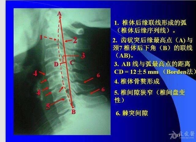 睡觉时不枕枕头能治颈椎病吗?