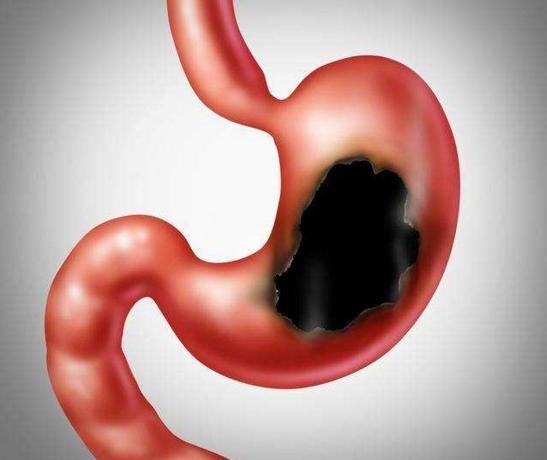 慢性胃炎上身，会发出6个信号，出现2个以上就得养胃了_【快资讯】