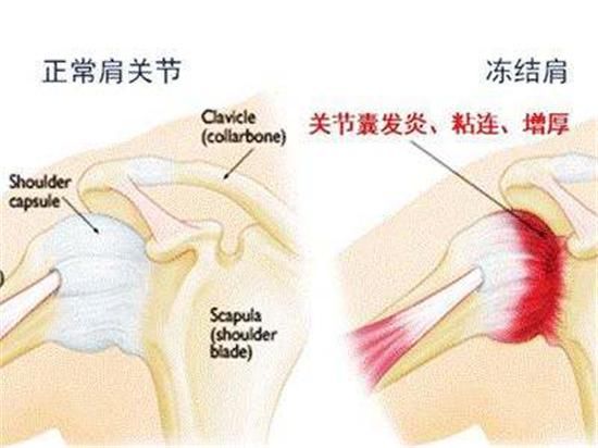 肩膀疼脖子疼手指麻怎么办？有1个简单有效的办法！