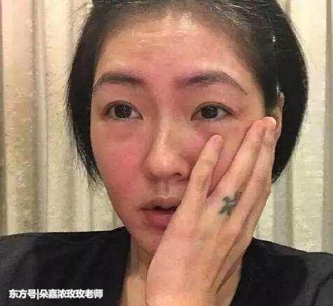 过度去角质脸上有红血丝容易脸红发烫烧的慌闷