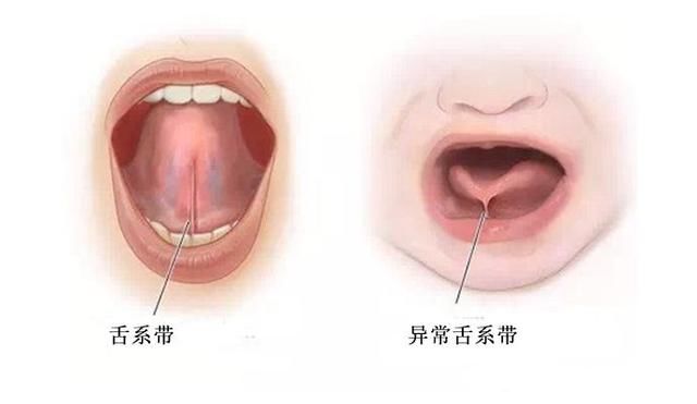 小儿常见问题科普：舌系带过短