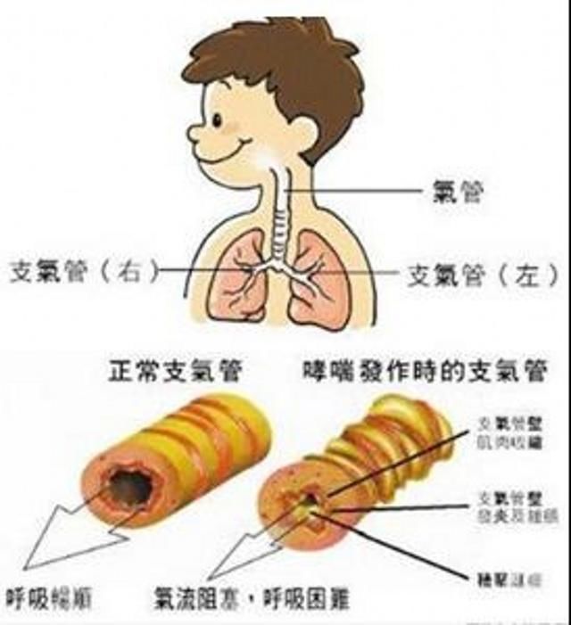 家长不得不知的小儿哮喘症状的识别与家庭护理！