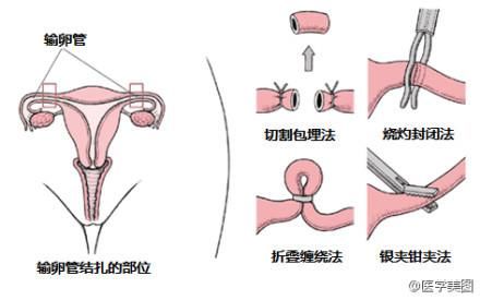 生完二胎，是结扎好，还是上环好，你会疼么？