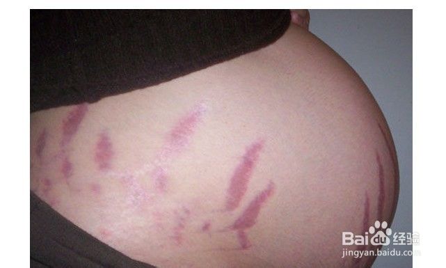 去妊娠纹产品排名_去妊娠纹进口产品(2)
