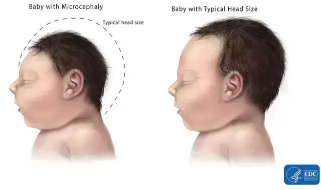 宝宝头围偏小对脑部发育是否有影响?如何判断