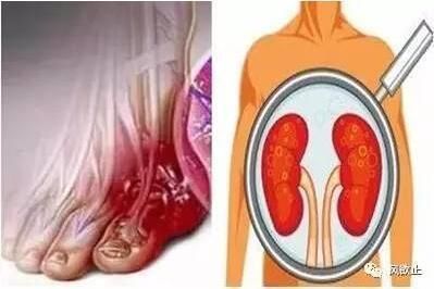 痛风毋需非布!中医内外结合,1个月尿酸就降到