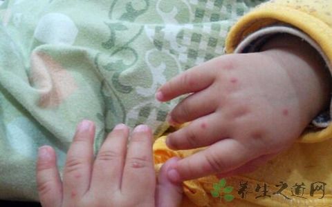 手足口病痒痒用什么药膏好