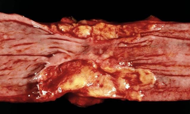 食管癌容易被忽视的5个早期症状,看完后,你还