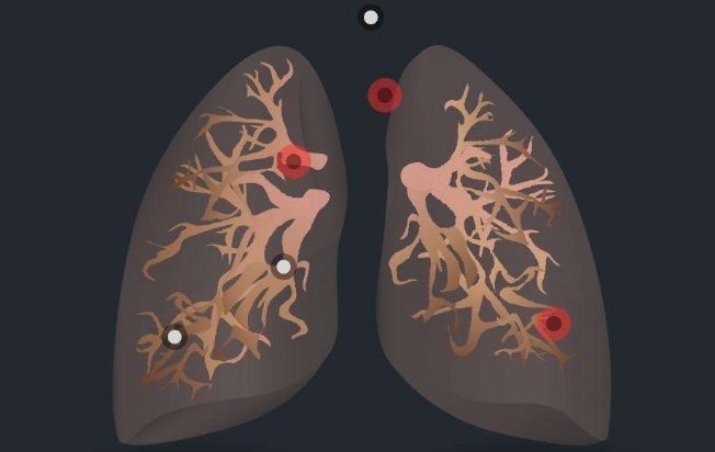 肺癌中心主任:下面5个症状是肺癌早期