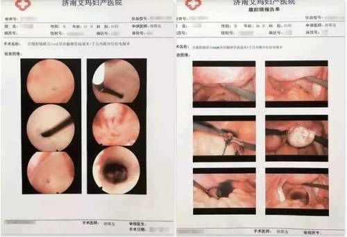 艾玛妇产宫腹腔镜联合手术助继发性不孕母亲圆生子梦