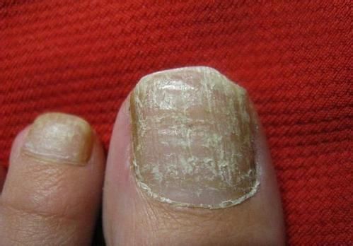 灰指甲的症状有哪些?解读灰指甲的病因及预防