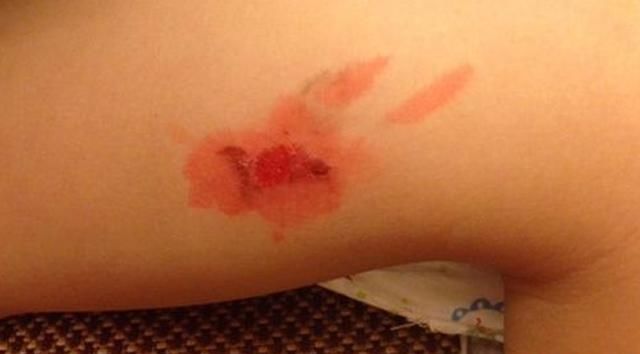 老婆被蒸汽烫伤脸了,该怎么处理?会不会留疤?