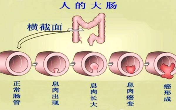 直肠息肉不典型增生的治疗方法?广州东大肛肠