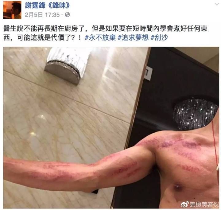 杨幂贾乃亮拔罐,刘涛佟大为刮痧,看大明星们都