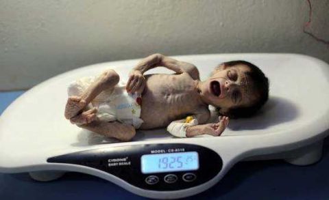 实拍:体重不到4斤的女婴,身体骨瘦如柴,如同一