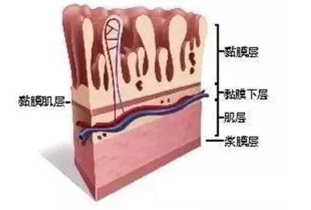 胃炎反复发作，老不好，正确修复胃肠粘膜是关键!