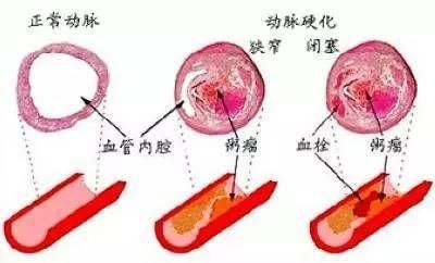 血管堵塞，当你有感觉时，已经晚了，早看早预防！