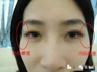 泪堂中有痣痕凹陷的女性,感情婚姻一塌糊涂,感