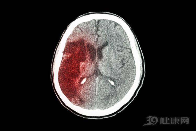 头痛剧烈险丧命!医生警告:7个症状是脑出血前兆