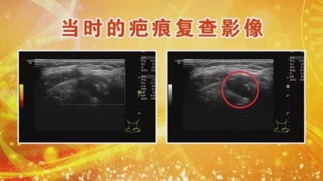 它是一种能摸到的恶性肿瘤,用手摸一摸,自检这种“危险分子”!