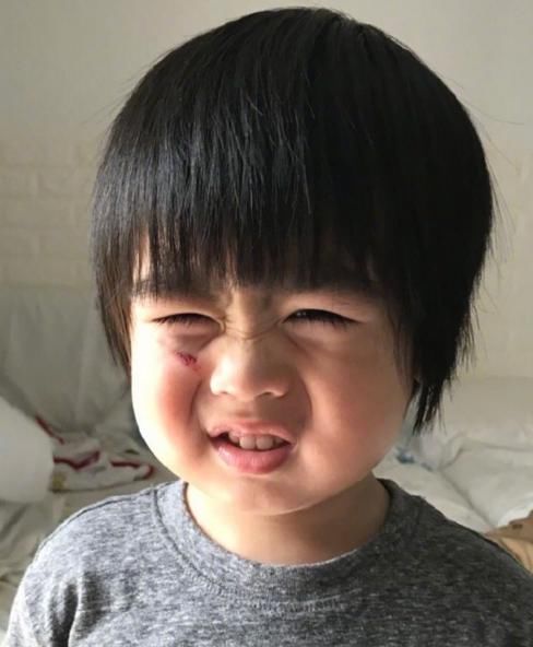 林志颖儿子跌伤脸 Kyson大眼呆萌不惧伤口模样