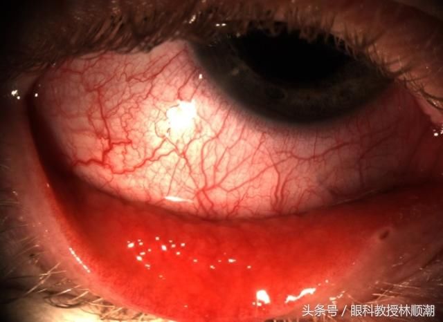 夏天须预防红眼病