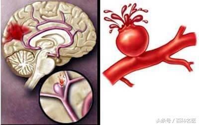 脑卒中这么可怕，哪些因素是“导火线”?教你3招自查中风!