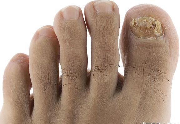 养成小百科:建议大家了解一下,甲癣