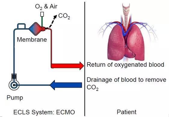 听说它能救命又很贵，“魔肺”ECMO究竟是啥?