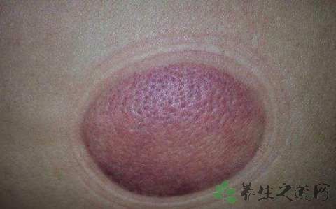 冬季预防肩周炎小常识