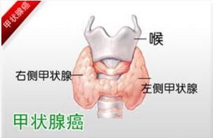 央视主持人朱迅甲状腺癌复发是真的吗？警惕甲状腺癌病因有哪些？