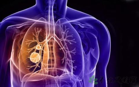 怎样区分肺结核和肺癌