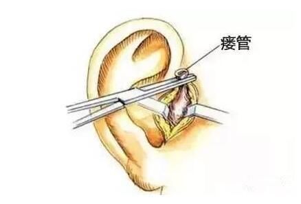 耳朵置管管子图样图片